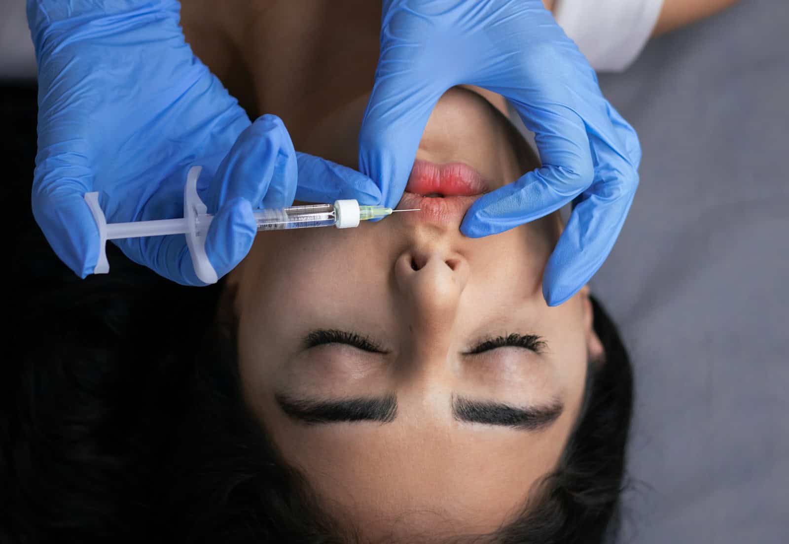 Lips receive an injection of filler.
